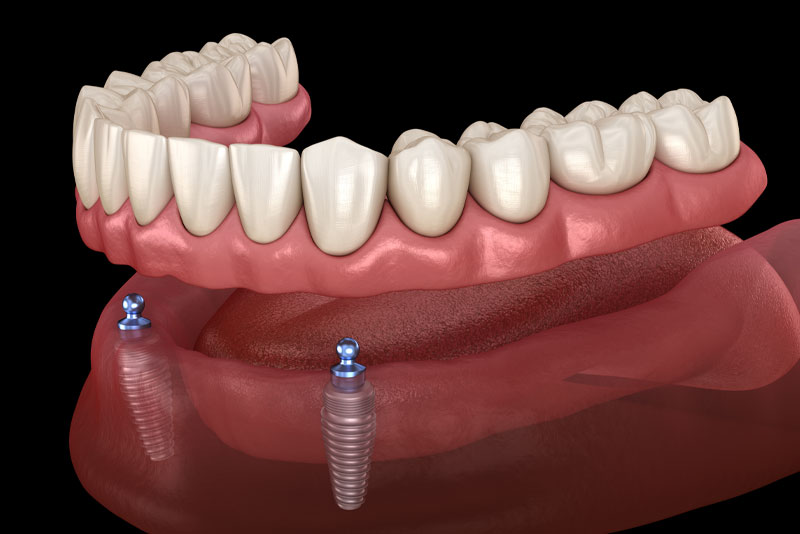 implant supported dentures model